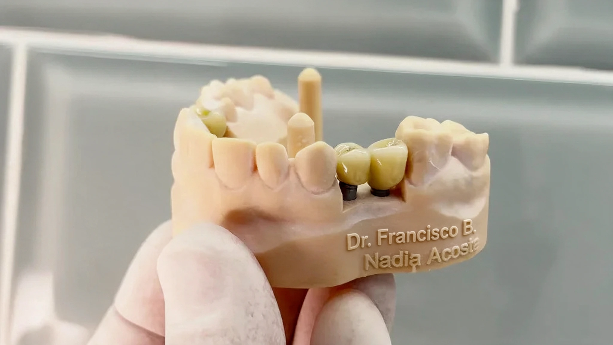 Implantes dentales